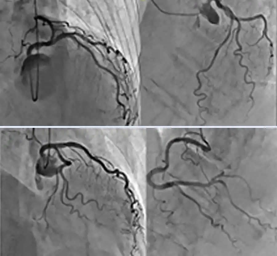放射線科_カテーテル