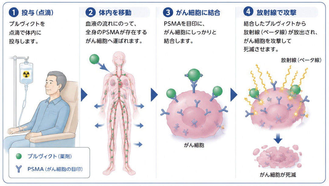 プルヴィクト治療